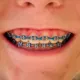 BracesBDSM