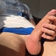 Vitiligo20
