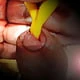 foleycatheter